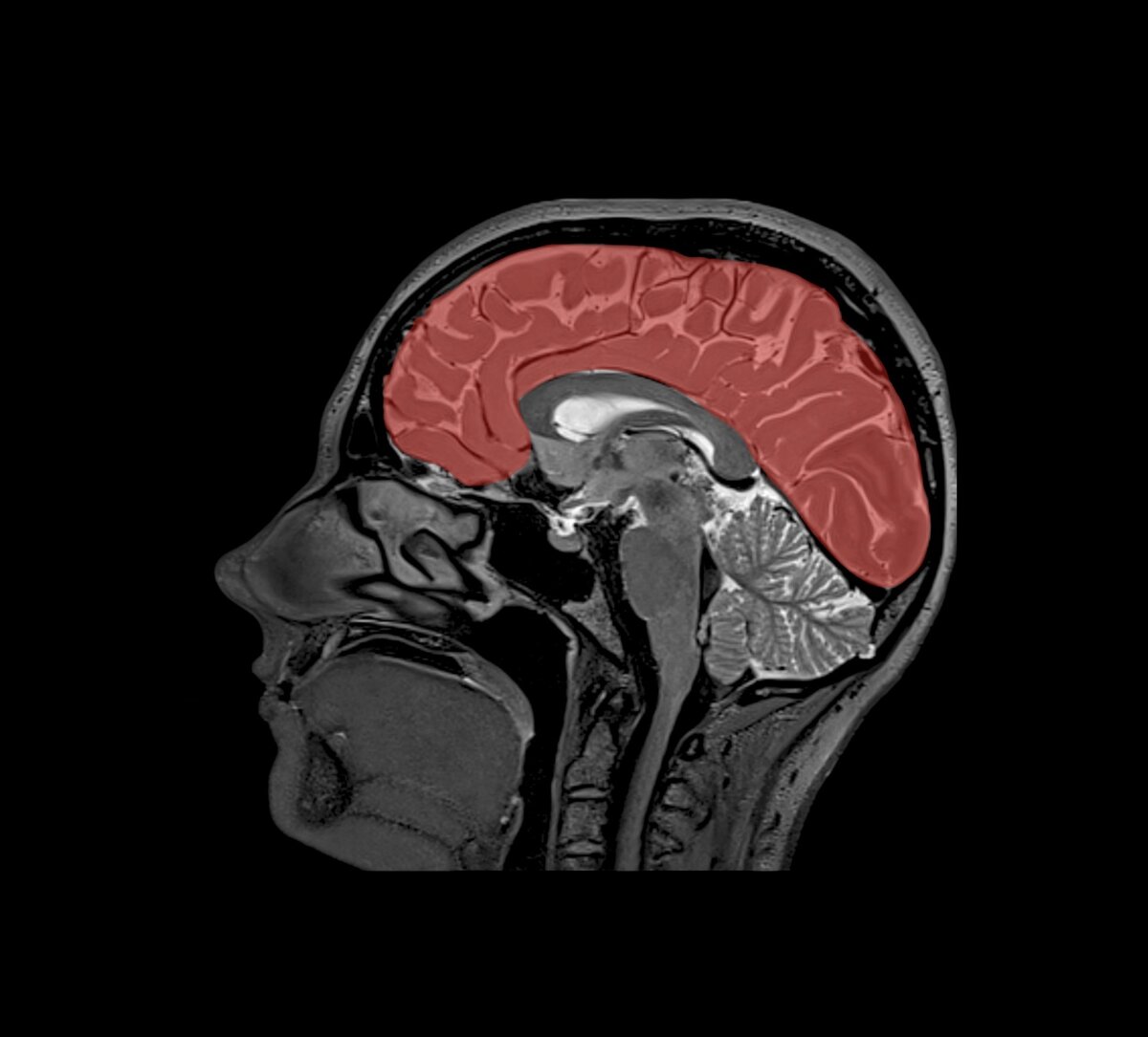 МРТ головного мозга человека. Кора мозга выделена красным цветом 