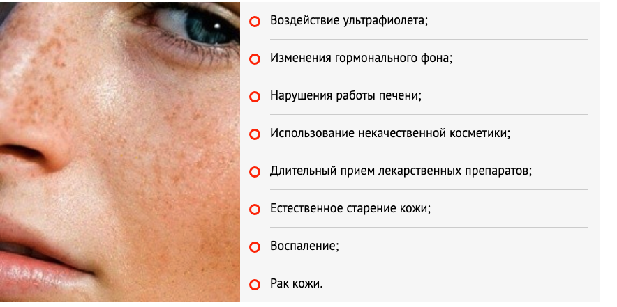 Причины появления пигментных пятен