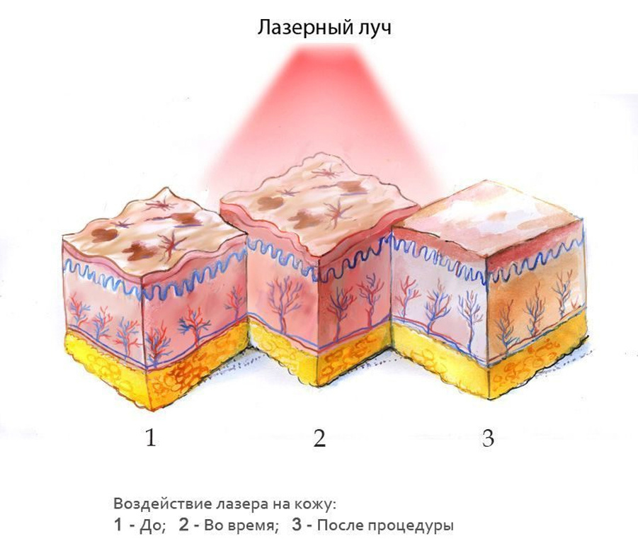 Лазер для лечения пигментации кожи