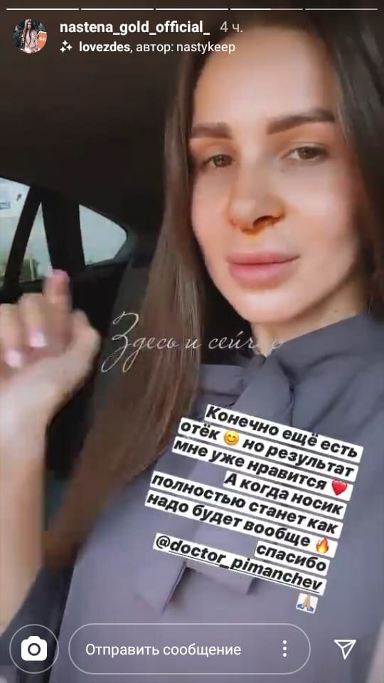 Настя показала, как сейчас выглядит её нос 
​Фото: «Инстаграм»
