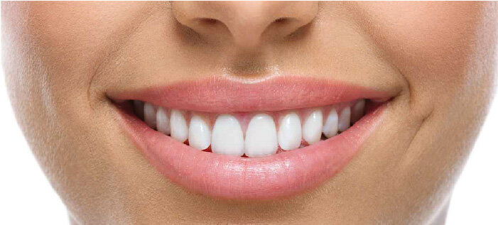 Ваша улыбка, когда стоят виниры.