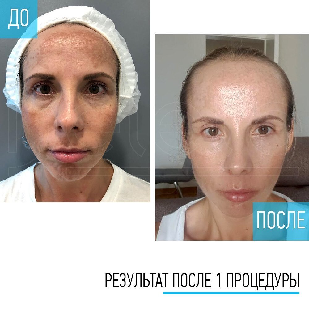 Проведена 1 процедура удаления пигментации на лбу на пикосекундном лазере PicoSure от Cynosure (благодарим за предоставленные фотографии клинику DELETE https://delete.ru/)