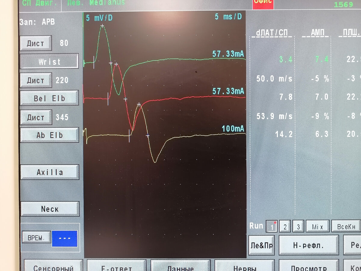 Другая рука - норма (дистальная латентность 3,4 мсек)
