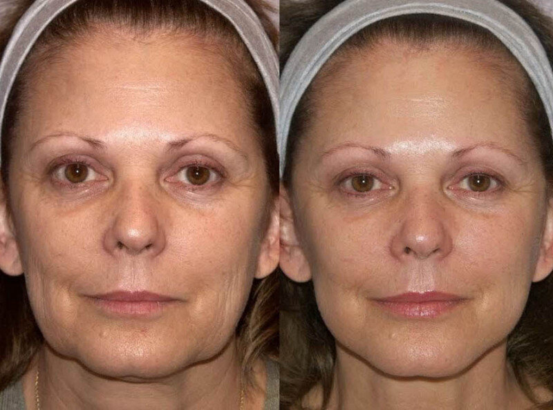 До и после введения нитей