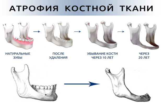 Как меняется кость с отсутствием зубов