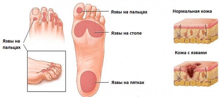 Огрубевшие пятки: способы лечения и очищения