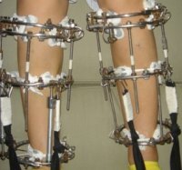 Аппарат Илизарова на две ноги.