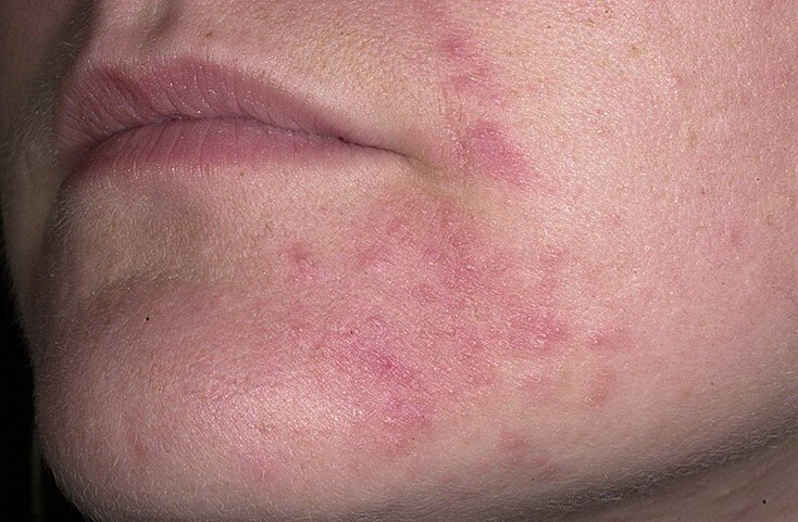 Аллергия на лице: симптомы, причины, лечение | Полисорб МП