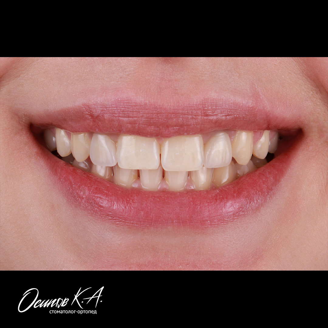 Итоговый результат после проведенного лечения