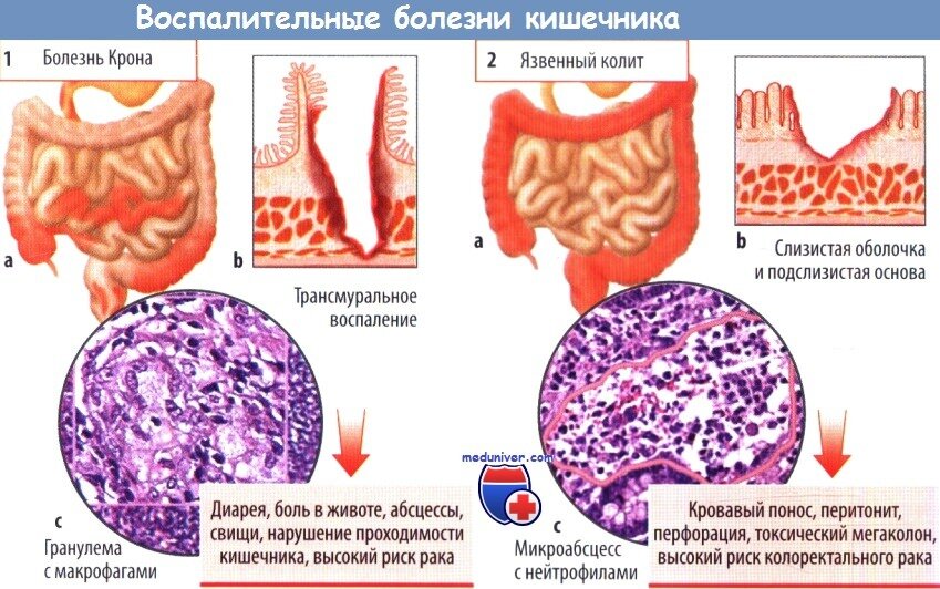 хронические воспалительные заболевания кишечника