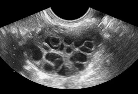 Поликистозный яичник.