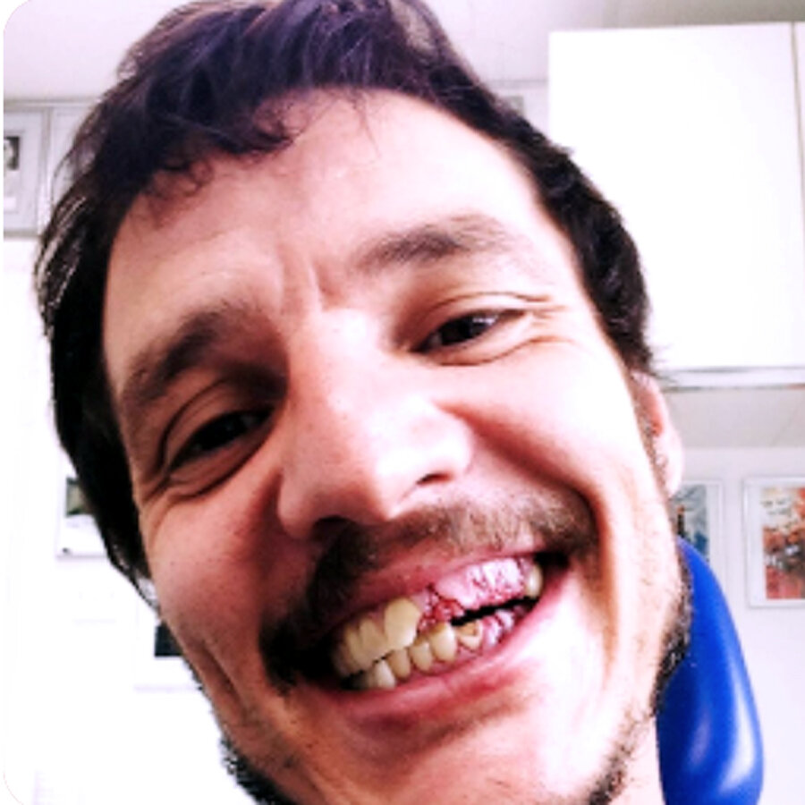 Специальные протезы и грим имитирующие сломанные зубы у актера.