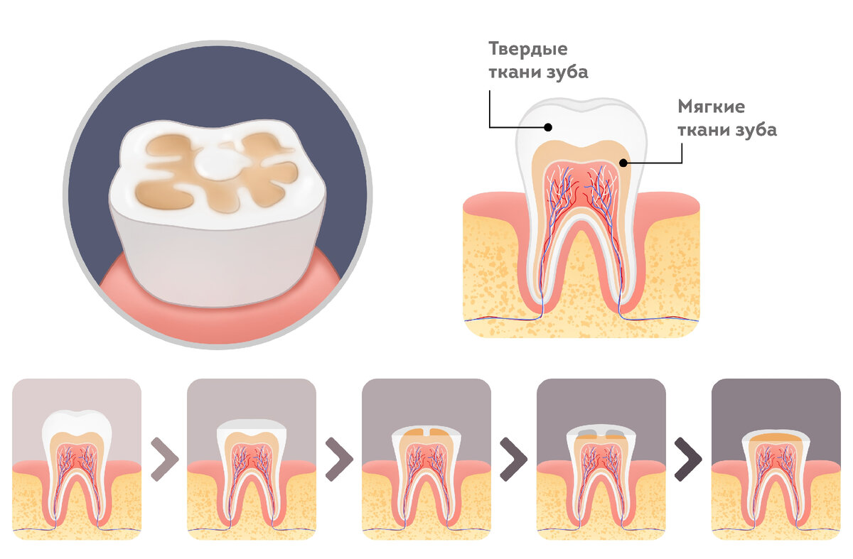Повышенная стираемость зубов — главное последствие бруксизма. В дальнейшем это может привести к нарушению прикуса и ранней потере зубов.  
Фото: dentbusik // Shutterstock