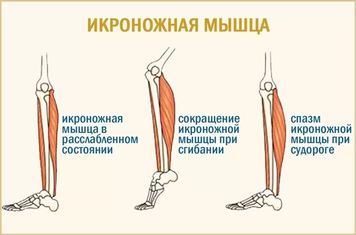 Почему сводит мышцы и как это исправить: причины и виды судорог | Флекс ...