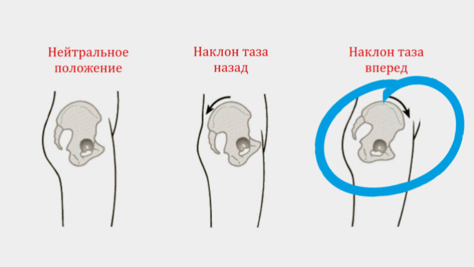 Как определить правильность расположения таза Боль в колене / торчит живот / боль в пояснице - проблемы разные, а причина одна