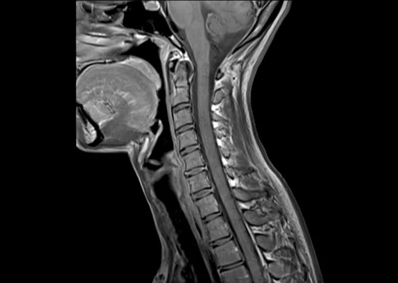 МРТ шейного отдела позвоночника: что показывает, когда назначается и как проходит диагностика
