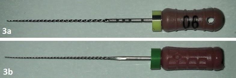 Удаление сломанного инструмента. Набор для удаления имплантатов. Удаление сломанного инструмента. Отлом эндодонтического инструмента в канале корня. Отломок инструмента в канале корня зуба.