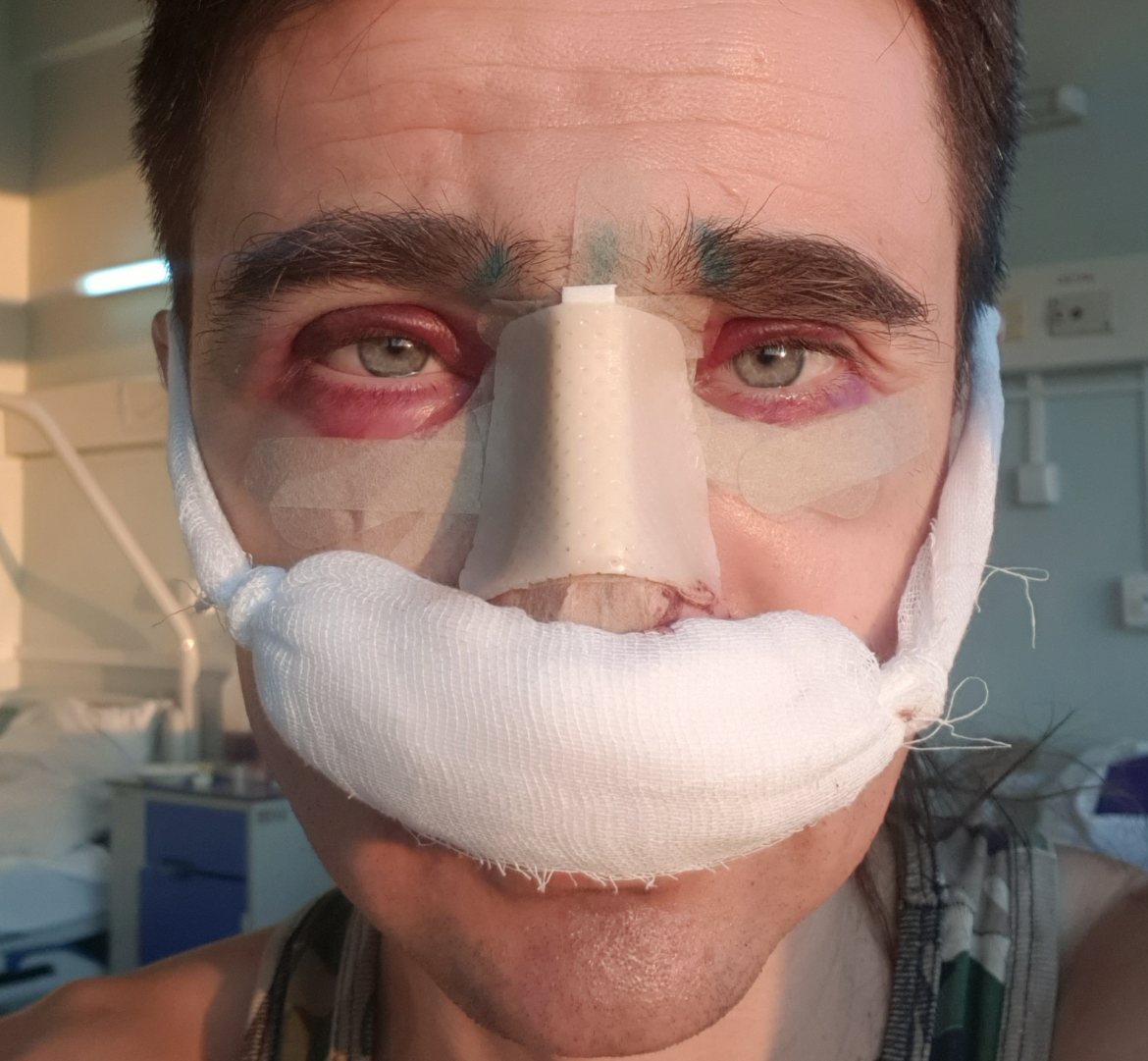 На второй день после операции