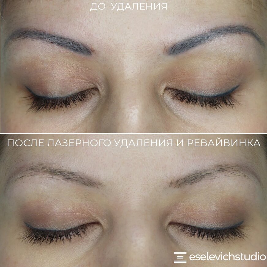 Брови после лазерного удаления и Ревайвинка