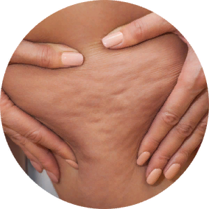 То что мы считаем целлюлитом называется гиноидная липодистрофия - рыхлая кожа на бедрах и ягодицах. И она встречается более чем у 85% женщин. Возникает он по причине неправильного питания, малоподвижного образа жизни и из-за вредных привычек.