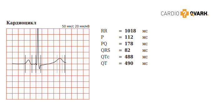 Пример ЭКГ I-отведения с удлиненным интервалом QTc на фоне длительного приёма антидепрессантов. Женщина, 66 лет. 
