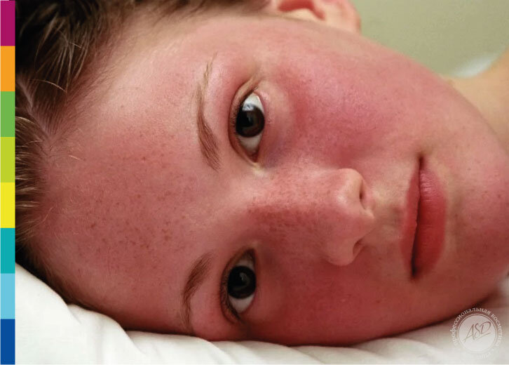 Покраснение кожи после пилинга - осложнение или желанный результат? 