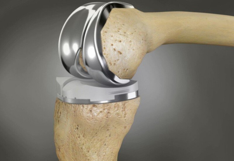 Титан совместим с биологической тканью и не вызвал ни единого случая аллергии и отторжения