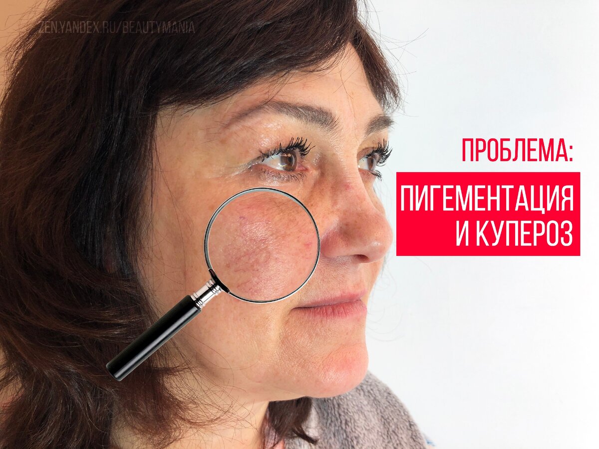 купероз и пигментные пятна на лице