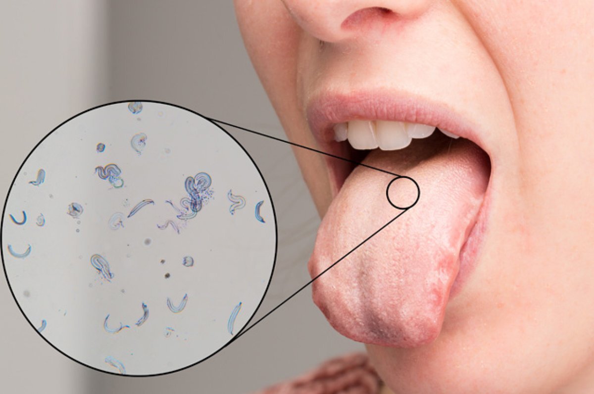    Расползающаяся проблема. Что надо знать о грибковых болезнях полости рта?