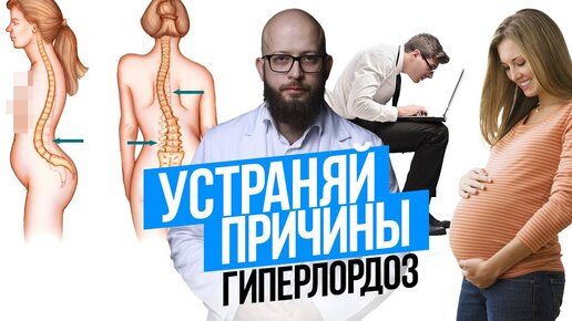 Гиперлордоз. Выпячивание живота. Причины и понимание проблем с телом.