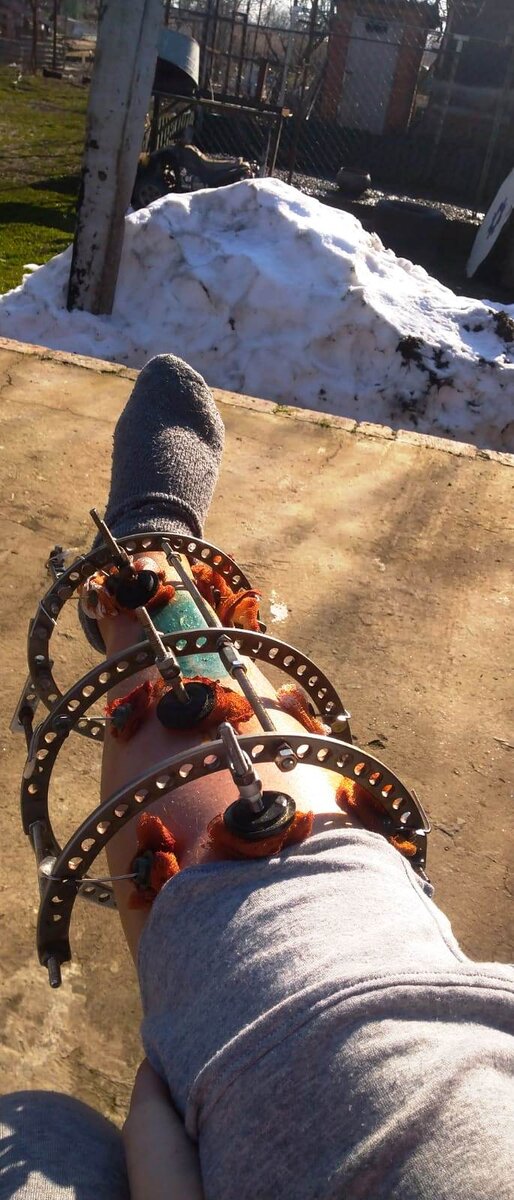 Это самое первое хождение на улицу, январь 2022, через 2 недели после установки аппарата. Дышу свежим воздухом во дворе.