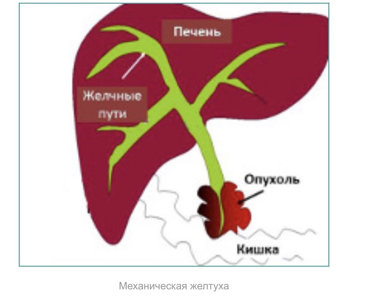 Увеличенный желчный пузырь причины. Синдром подпеченочного холестаза. Подпеченочная желтуха холестаз.