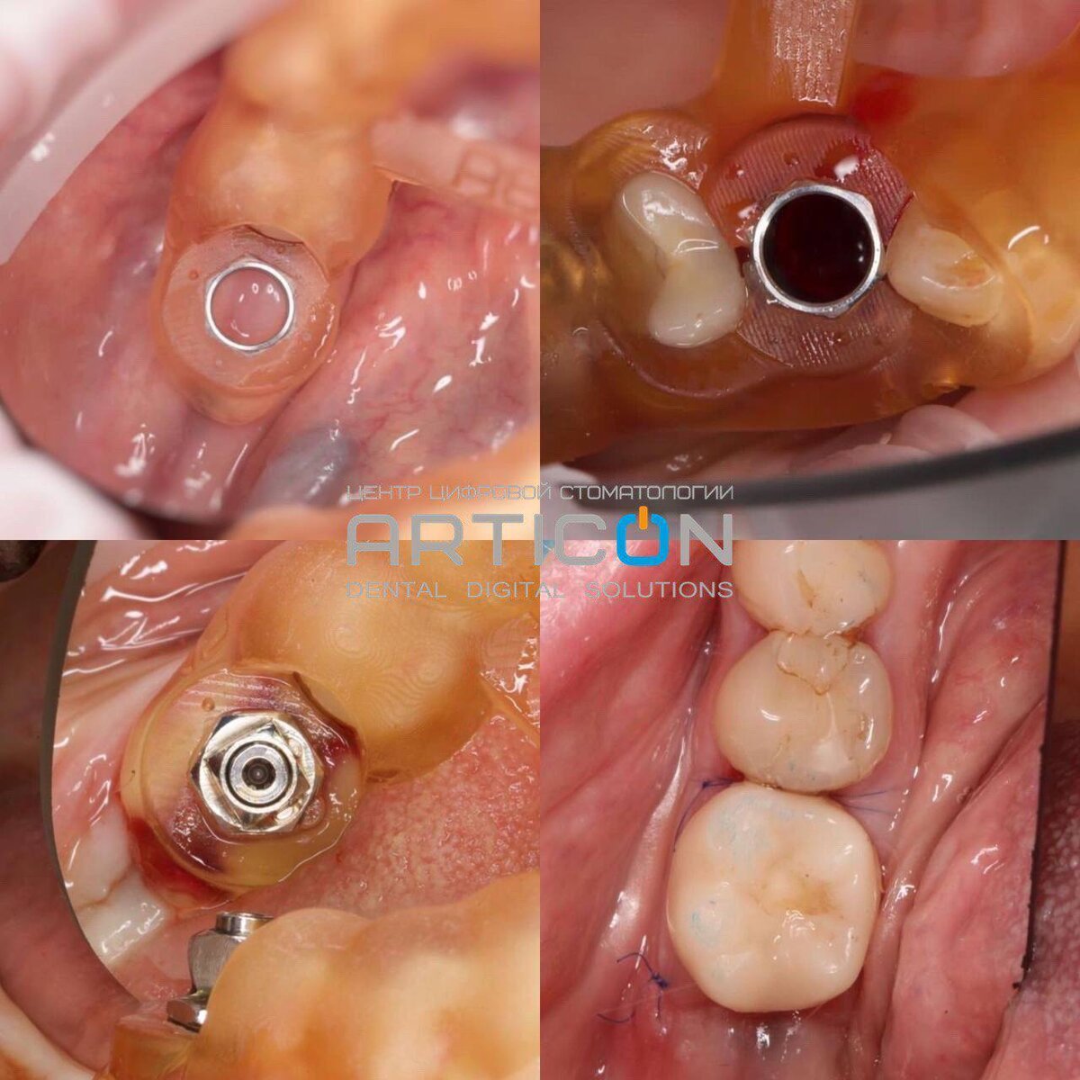 Вся правда об имплантации зубов. Что вас ждет? | ARTICON цифровая  стоматология в Москве | Дзен