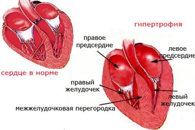 Гипертрофия левого желудочка сердца: что это и как можно лечить