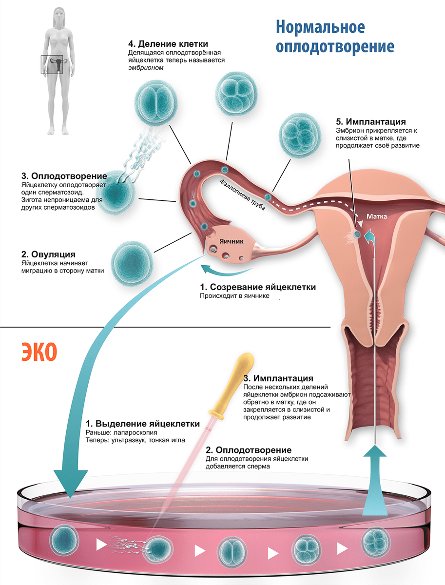 У вас эко или сами забеременели?Напишите в коментах