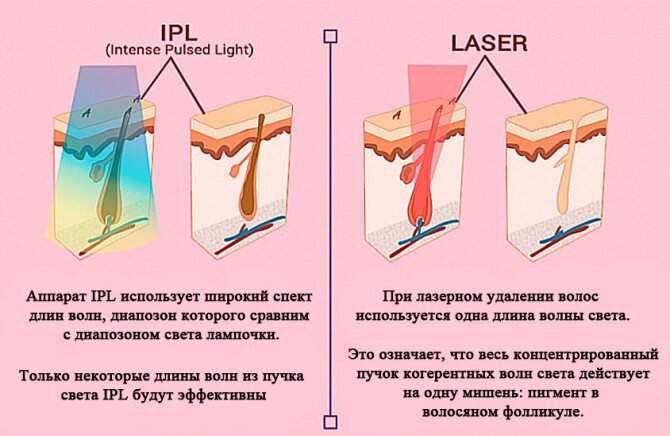 Как выбрать свой лазер для удаления волос? Какие лазеры бывают: александрит, диодный, неодимовый, IPL