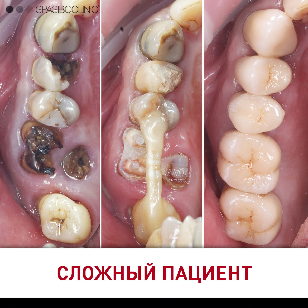 Почему гниют зубы, причины, стадии и лечение