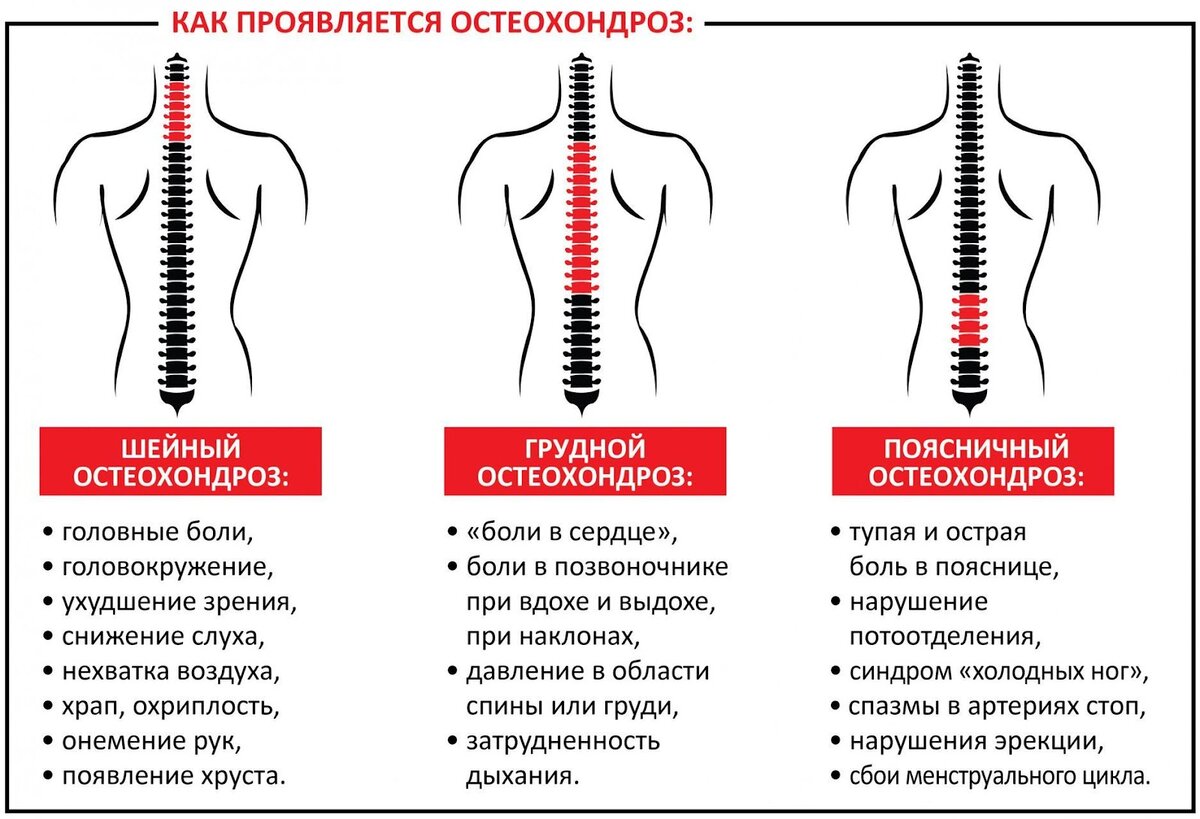 Остеохондроз — от причин до лечения | Evolutis Clinic | Дзен