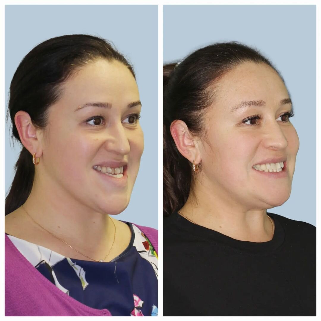 История ортодонтического лечения | Марков Николай Михайлович | Дзен