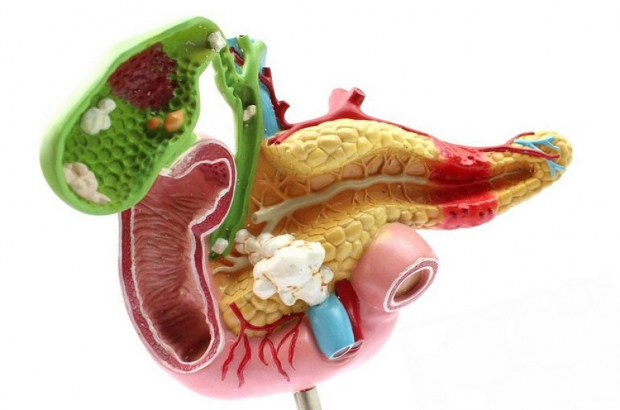 Лечение поджелудочной желчного пузыря. Желчекаменная болезнь холелитиаз. Острый панкреатит поджелудочной железы. Панкреатит и желчекаменная болезнь. Камни в желчном пузыре и поджелудочная железа.