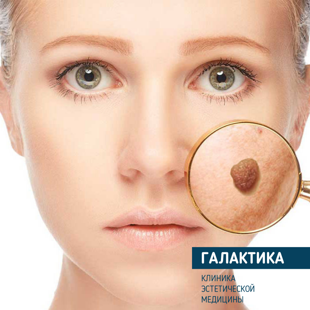 Как избавиться от кератомы? Осложнения после удаления новообразования ...