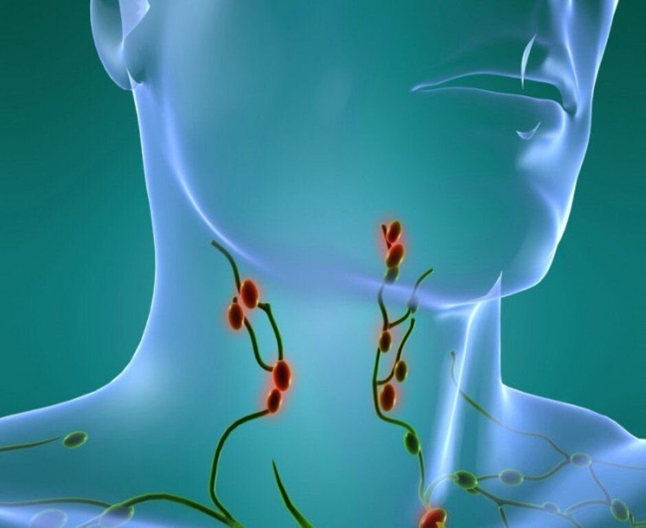 лимфатические узлы лимфома. облучение лимфоузлов. облучение лимфоузлов. опухоли полости рта на кт. облучение лимфоузлов.