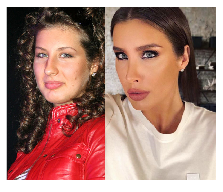 Алина алексеева фото до и после пластики
