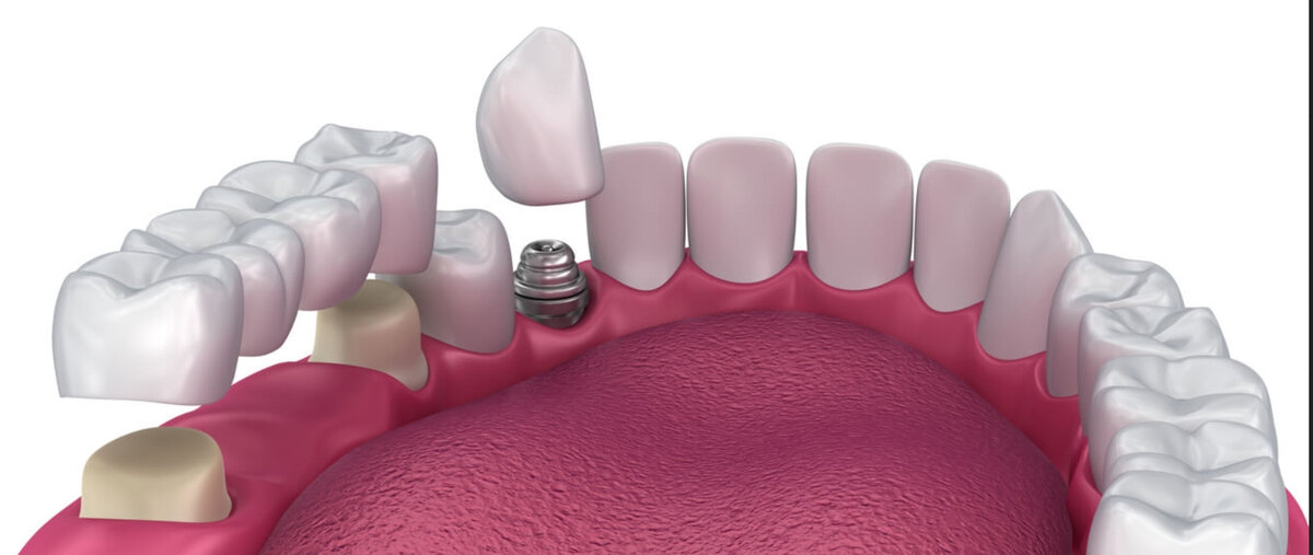Стоматология мост что это такое