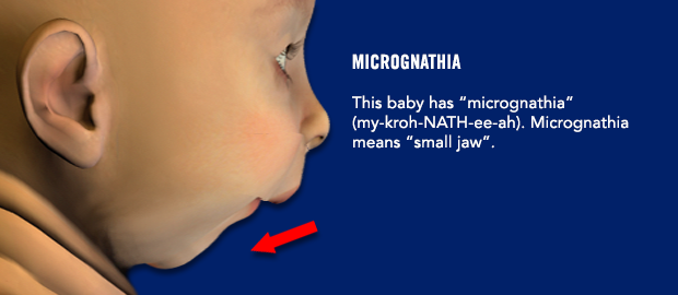 Микрогнатия новорождённых. Микрогнатия нижней челюсти у новорожденного. Микрогнатия скученный.
