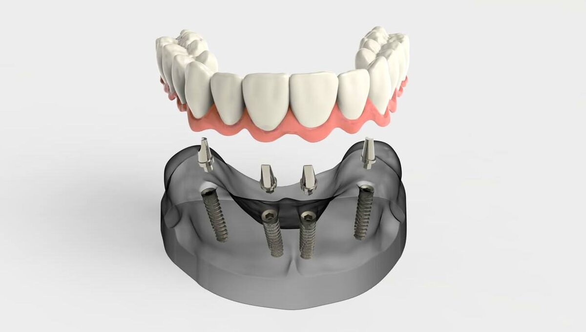 Фото нижняя челюсть на имплантах