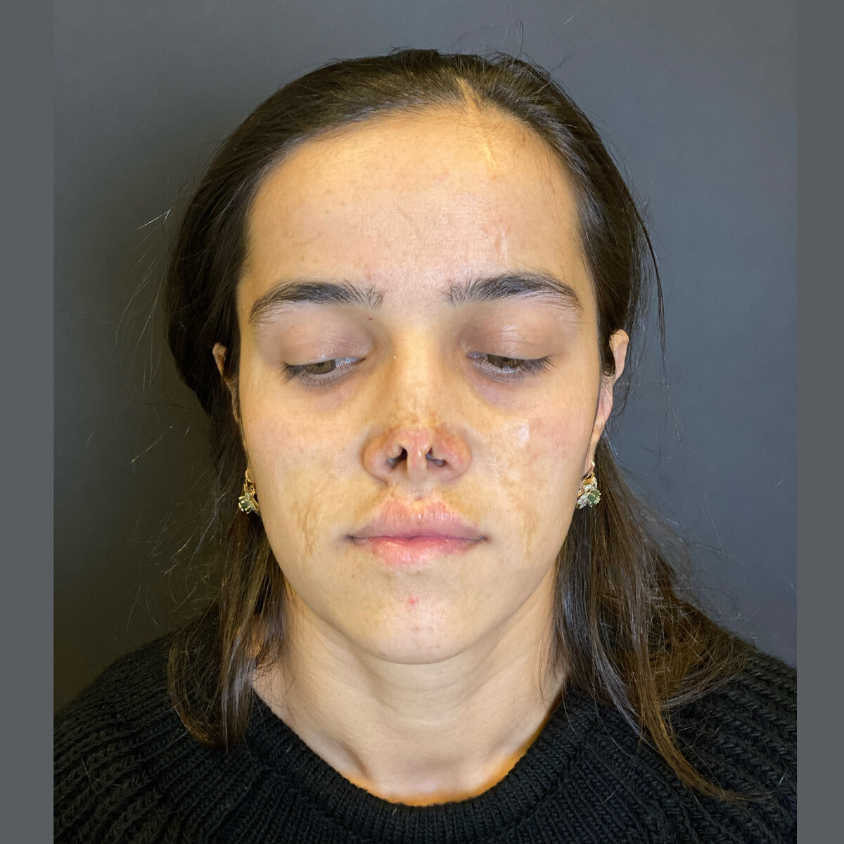 До операции "Реконструктивная ринопластика"