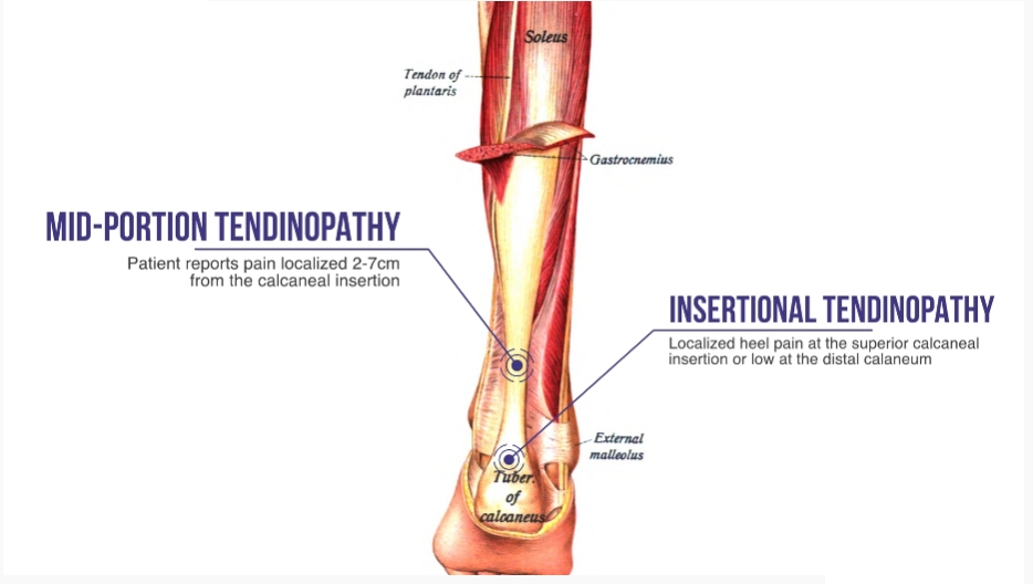 Ахиллово сухожилие тендинит. Тендинопатия ахиллова сухожилия. Ахиллово сухожилие воспаление. Воспаление ахиллового сухожилия на ногах.