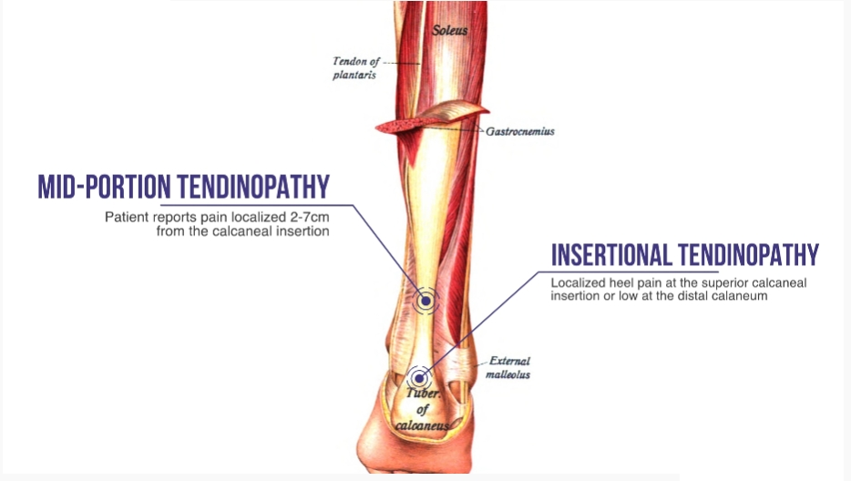 Места локализации боли при тендинопатии Ахиллова сухожилия.