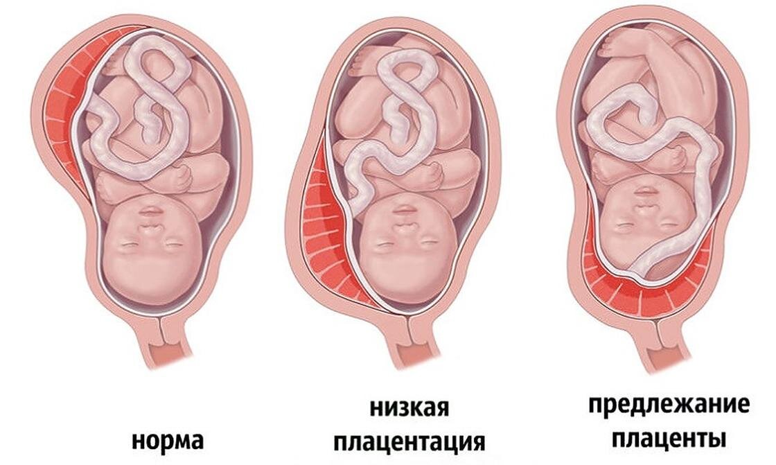 Толщина плаценты по неделям беременности